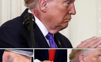 donald Trump shown with visible bruising on his neck and hand in multiple close-up